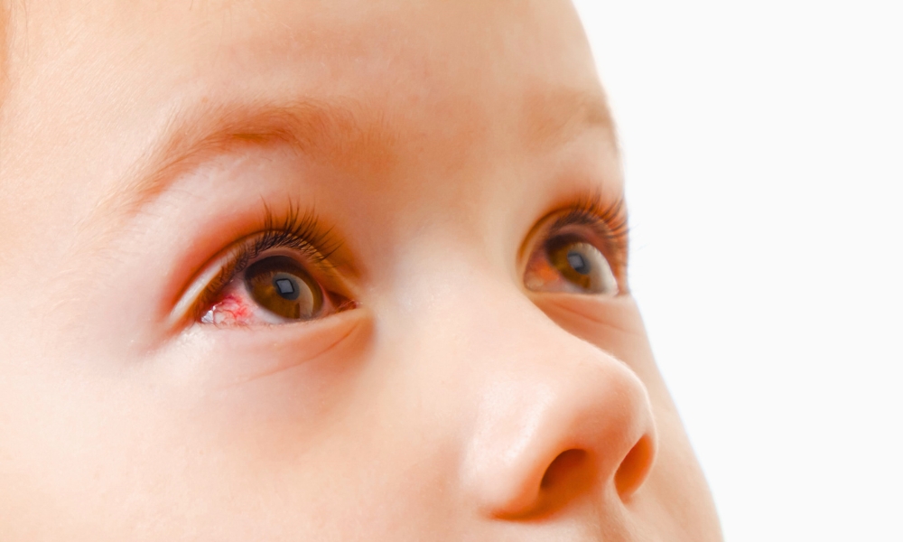 konjuktivitis kod dece