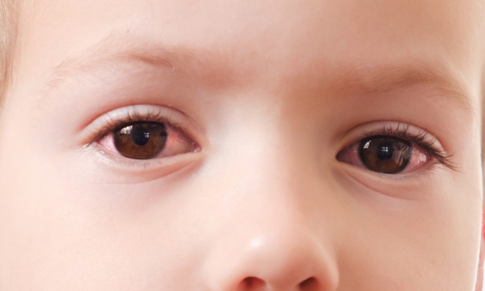 konjuktivitis kod dece